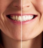 שיניים גדולות - תמונת המחשה